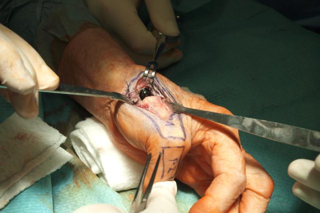 Operace ruky,  ilustrační foto | foto: Nemocnice Havlíčkův Brod