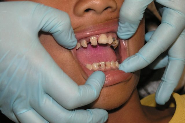 u zubaře,  zuby,  zubní kaz,  parodontóza,  stomatologie,  zubař | foto: CC0 Public domain